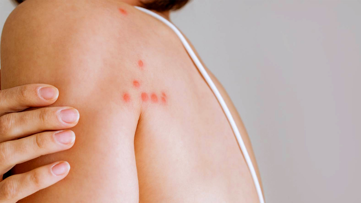 C’est confirmé : ces 5 signes révèlent une piqûre de punaise de lit